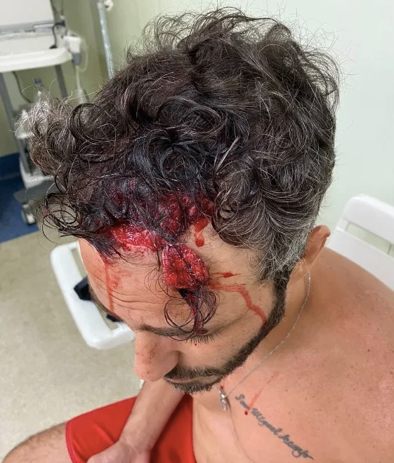 Thiago Rodrigues - machucado após assalto