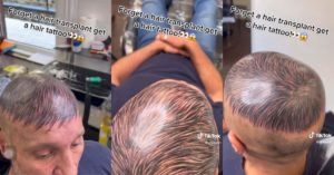 Tatuagem capilar careca