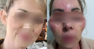 Mulher - botox