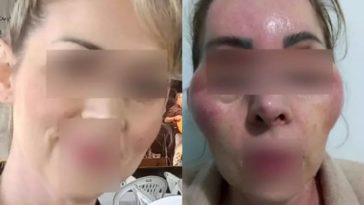 Mulher - botox