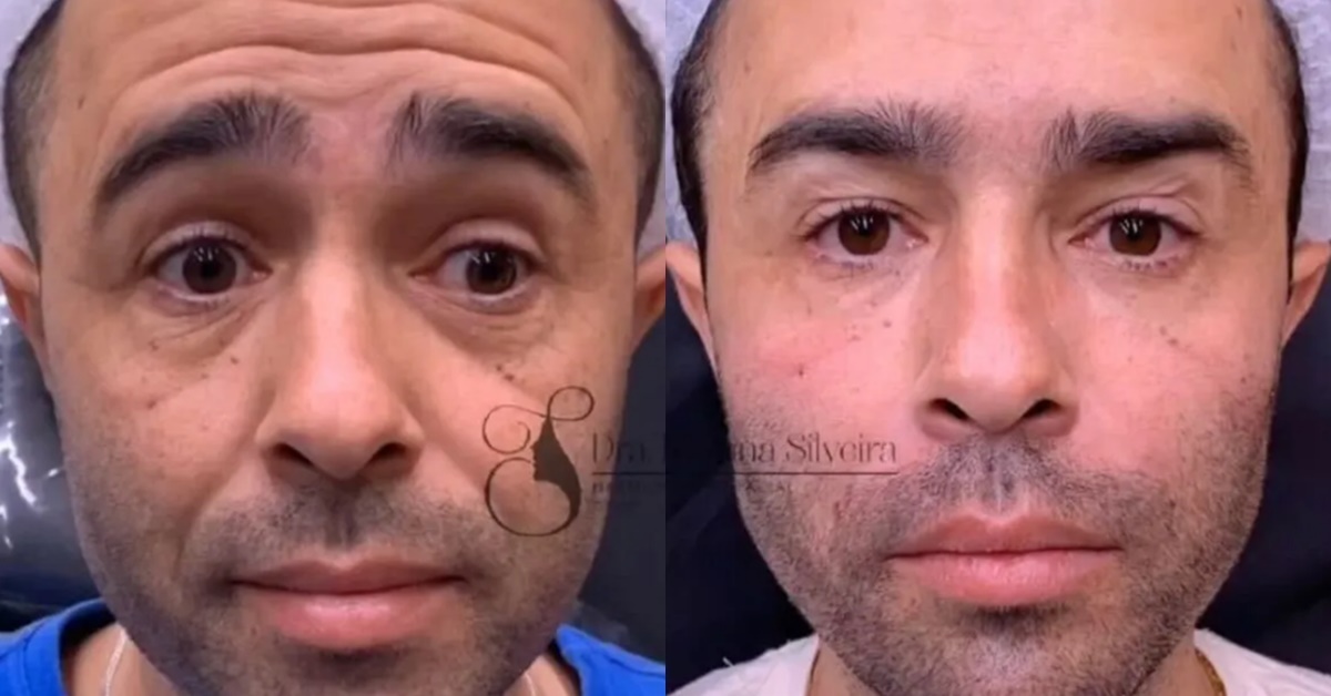 harmonização facial - Diones Coelho