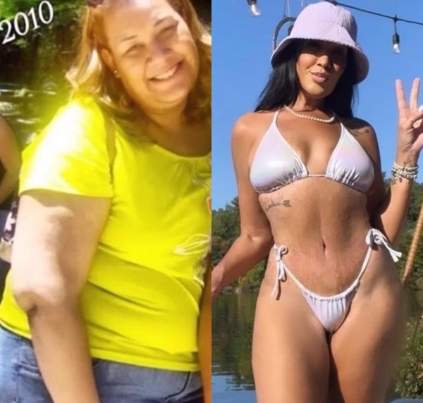 antes e depois - bariátrica - Mila de Jesus